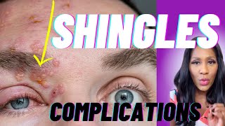 SHINGLES DANGERS Postherpetic Neuralgia Ramsay Hunt Syndrome amp Zoster Opthalmicus [upl. by Ema132]