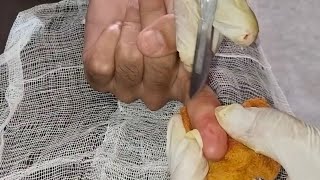 Ganglion Finger Cyst Removal Surgery [upl. by Debi32]