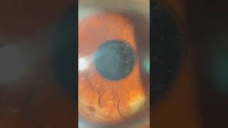 Secondary cataract  Conquering Posterior Capsular Opacity Now [upl. by Harima739]