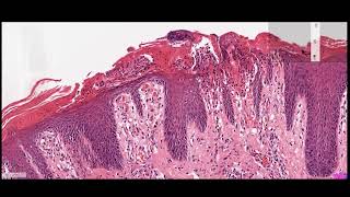 dermatopathology of psoriasis [upl. by Aiderfla108]