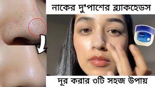 Blackheads and whiteheads removal 👌facial how to reduce acne pimple blackheadsget fairclear skin [upl. by Isiah]