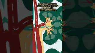 MRCP Exam tip CGPA vs EGPAGranulomatosis with polyangiitis [upl. by Sethi527]