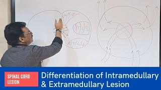 Localisation of Spinal Cord Lesion Intra medullary amp Extra medullary lesions [upl. by Sahcnip]