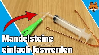 Mandelsteine selbst entfernen und ausdrücken  Mandelsteine loswerden 😷 [upl. by Refennej]