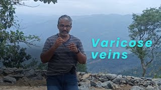 Varicose veins Malayalam [upl. by Orian]