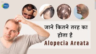 जाने कितने तरह का होता है Alopecia Areata  Types of Alopecia  Alopecia Areata Treatment [upl. by Osnohpla290]