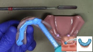 Laboratory Reline for LOCATOR and LOCATOR RTx Dentures StepByStep Technique [upl. by Eugenle]