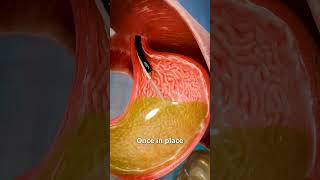 how a gastric balloon works 🤔  🙏subscribe please🙏 [upl. by Edna]