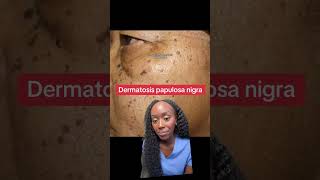 Why Do I Have These Dark Skin Spots Understanding Dermatosis Papulosa Nigra [upl. by Iluj]