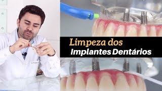 Limpeza de Implantes Dentários  3 Técnicas de Higienização [upl. by Pope]