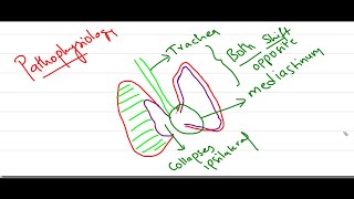 Tension Pneumothorax [upl. by Yemrej]