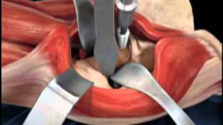 Depuy Direct Anterior Total Hip Replacement Animated Video [upl. by Leila]