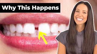 Why Do People Have GAP TEETH amp How To Fix It Diastema Explained [upl. by Ahaelam]