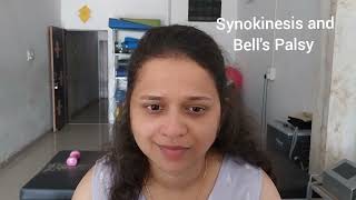 Synkinesis vs Bells Palsy Different between Synkinesis and Bells Palsy [upl. by Novad]