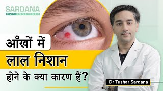 Causes of Red Spot in Eye Aankho me Khoon Aana  Eye Specialist in Delhi  Dr Tushar Sardana [upl. by Gibert370]