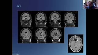 AES Professors Rounds Video EEG Cases [upl. by Atsirhc107]