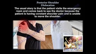 Shoulder Dislocation posterior  Everything You Need To Know  Dr Nabil Ebraheim [upl. by Naitsabas]