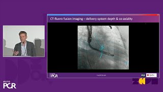 Transformative imaging in the clinical pathway of transcatheter tricuspid valve interventions [upl. by Aniras]