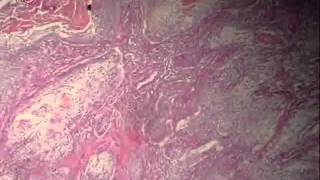 Bronchogenic carcinoma عملي عبد الرحمن خليفة [upl. by Femmine]