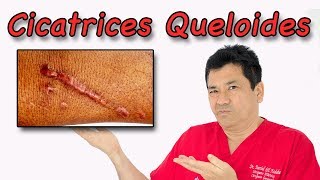 ¿Qué son las Cicatrices Queloides y cómo Tratarlas [upl. by Ellsworth]