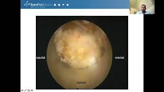 Endoscopic facet joint amp SI joint denervation initial experience [upl. by Earaj]