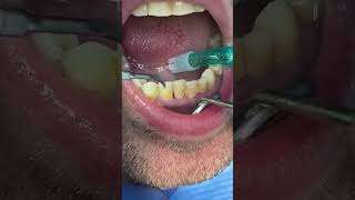 Igiene dentale professionale tramite strunento ad ultrasuo [upl. by Gorton]