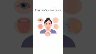 Sjogren’s Syndrome kattrucate medicalreels sjogren syndrome triads arthritis shorts [upl. by Soalokcin]