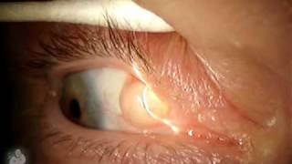 Parsons Series Disease of Eye Glaucoma  Part 1  Dr Niha Aggarwal  DBMCI  eGurukul [upl. by Rundgren]