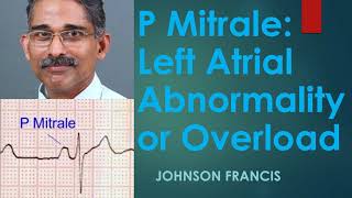 P Mitrale – Left Atrial Abnormality or Overload [upl. by Debarath]