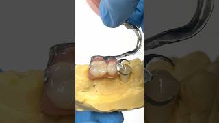 Adding a Crown for a Metal Clasped Partial lsk121shorts dentistry teeth [upl. by Anwahsiek18]