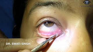 Lacrimal Syringing Technique and Interpretation [upl. by Natalia176]