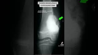 PADRÃO RADIOLÓGICO OSTEOSSARCOMA ortopediaetraumatologia medicina ortopedia OSTEOSSARCOMA [upl. by Enoed152]