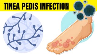 Tinea Pedis Infection Athletes Foot  Causes Types Signs amp Symptoms And Treatment [upl. by Weksler899]