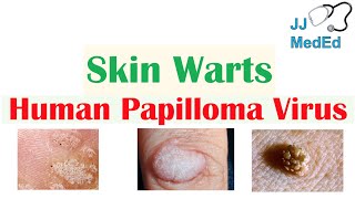 Overview of Skin Warts Verrucae  What Causes Them Who Gets Them  Subtypes and Treatment [upl. by Ayk]