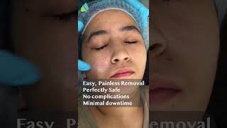 Mole wart removal with painless RF laser [upl. by Ursala]