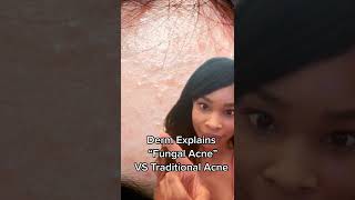 Why those tiny bumps arent Fungal Acne [upl. by Akayas]