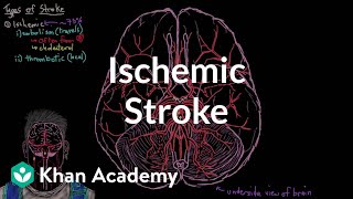 Ischemic stroke  Circulatory System and Disease  NCLEXRN  Khan Academy [upl. by Bobbette]