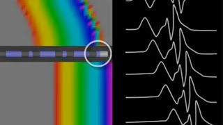 Ablation target for WPW Differential Pacing Maneuvers SVT EPS in Cardiac Electrophysiology [upl. by Labinnah]