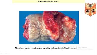 Male Genital System Pathology Penile and Testicular Areas [upl. by Addam77]