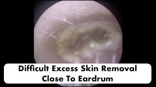 VERY DIFFICULT DEAD SKIN REMOVAL CLOSE TO THE EARDRUM  Ep 18 [upl. by Fawcette]