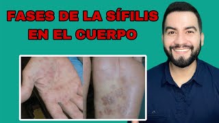 FASES DE LA SÍFILIS  SIGNOS Y SÍNTOMAS DE LA SÍFILIS  DR DAVID CAMPOS [upl. by Errot]