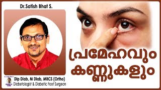 പ്രമേഹവും കണ്ണുകളും  DrSatish Bhats  Diabetic Care India  Malayalam Health Tips [upl. by Diver469]