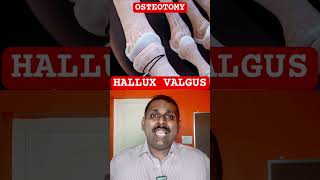 HALLUX VALGUS procedure [upl. by Thebazile355]