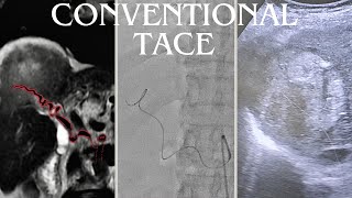 Managing Advanced Hepatocellular Carcinoma in an Elderly Patient A Case Study [upl. by Radack238]