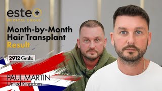 Hair Transplant Turkey Results Month by Month 2912 Grafts hairtransplantresults hairtransplant [upl. by Fafa]