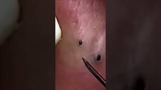 Milia Cysts Removal Blackheads On Face At HomeEp73 malia cysts [upl. by Apul]