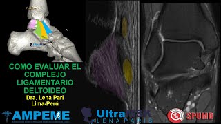 Como evaluar el complejo deltoideo del tobillo en ultrasonido o ecografía [upl. by Ahsirtak]