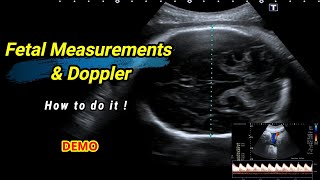 Fetal measurements and Doppler  How to do it [upl. by Howarth]