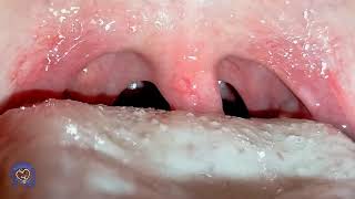 how Tonsil Stones are removed [upl. by Kimberly]