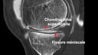 Chondropathie fémorotibiale et Arthroscanner [upl. by Elsa]